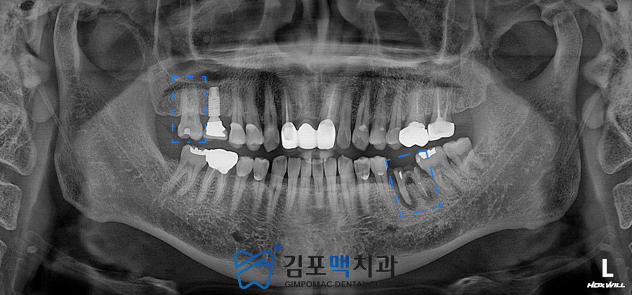 검단임플란트치과