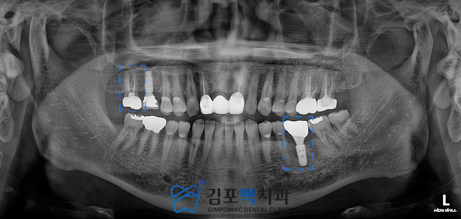 검단임플란트치과