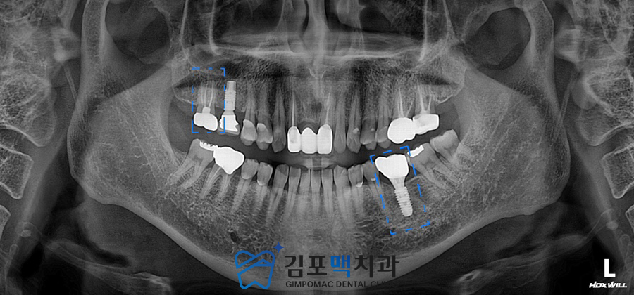 검단임플란트치과