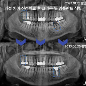 검단임플란트치과