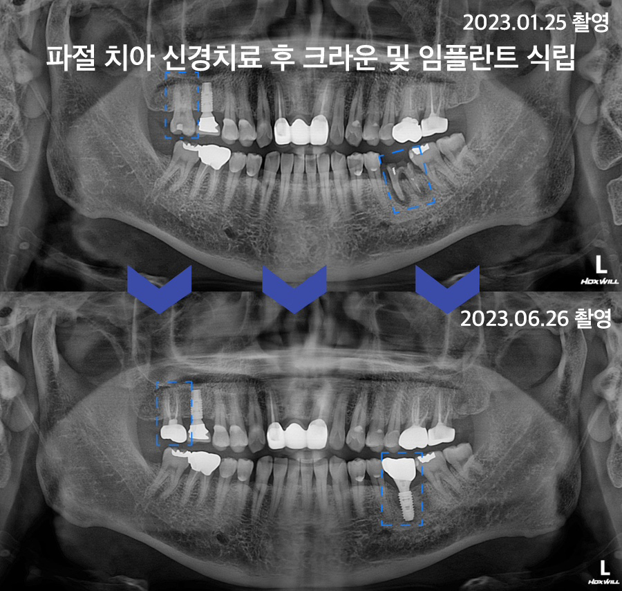 검단임플란트치과