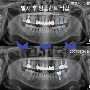 감정동임플란트6