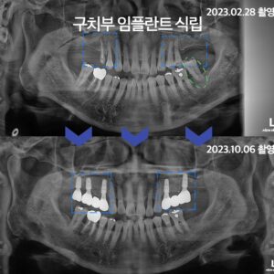 감정동임플란트