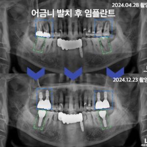 북변동임플란트5