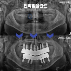 전악임플란트