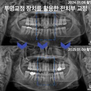 투명교정